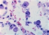شیوع وجود آنتی ژن سیتومگالوویروس (CMV) در بیماران روماتوئیدی